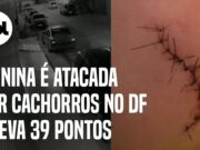 Menina é mordida por 2 cachorros e precisa de 39 pontos no rosto; veja ataque