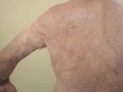 Atendimentos a queimados aumentam em 31% no estado