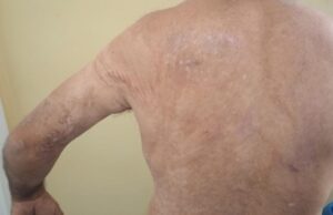 Atendimentos a queimados aumentam em 31% no estado