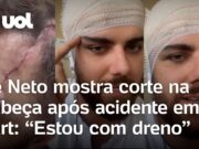 Zé Neto mostra ferimento na cabeça após acidente em kart: ‘Corte foi bem grande’