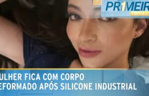 Mulher fica com corpo deformado após aplicação de silicone industrial; veja