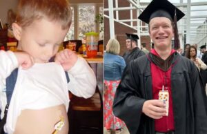 Homem com doença rara passa 20 anos comendo apenas três alimentos; veja