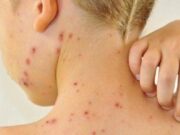 Saúde alerta para um possível surto de sarampo em Mato Grosso