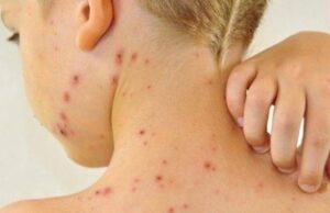 Saúde alerta para um possível surto de sarampo em Mato Grosso