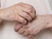 Sarampo acende alerta com proximidade de grande show