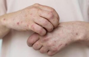 Sarampo acende alerta com proximidade de grande show